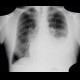 Pleural effusion, pneumothorax, PNO, inverstion of hemidiaphragm: X-ray - Plain radiograph